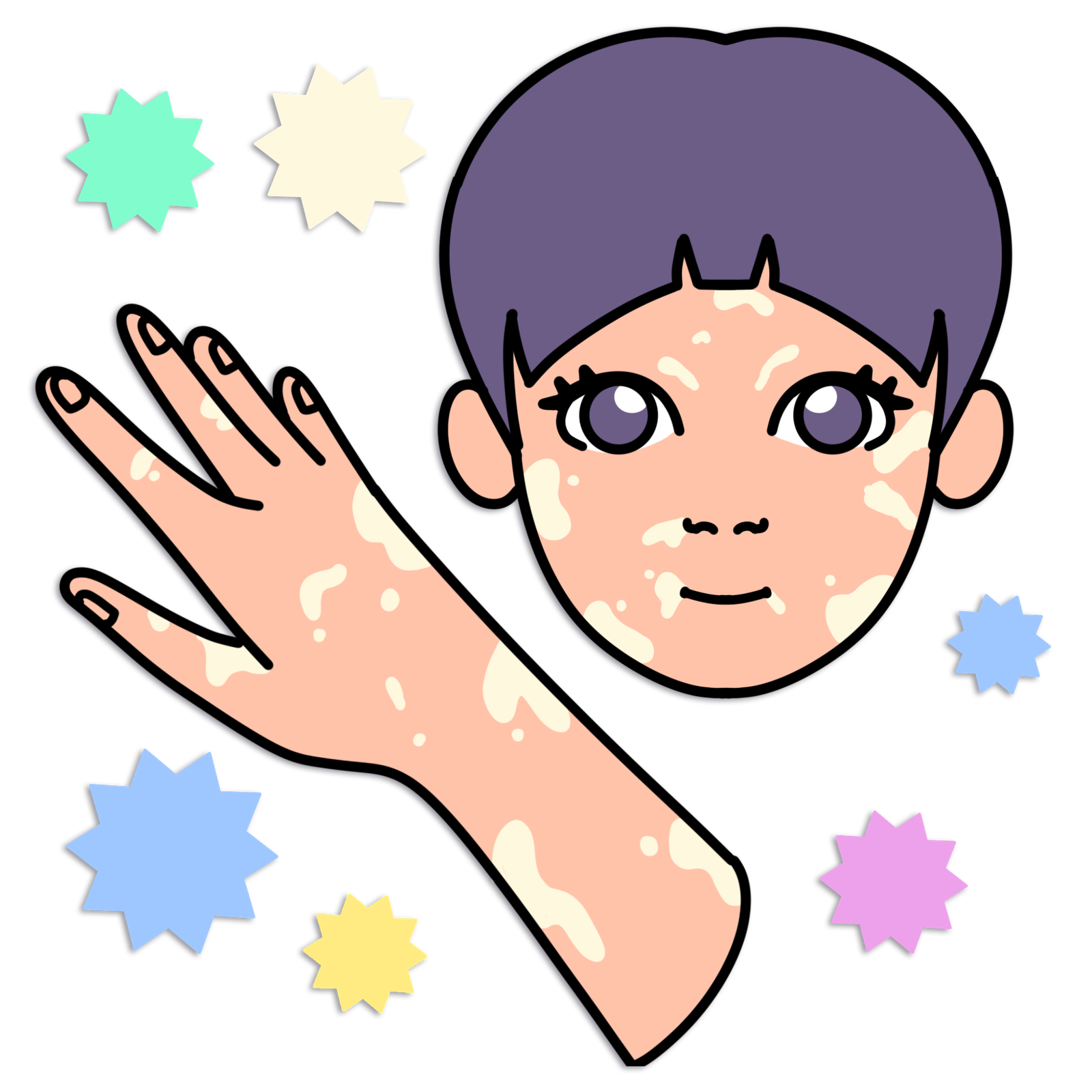 vitiligo ano